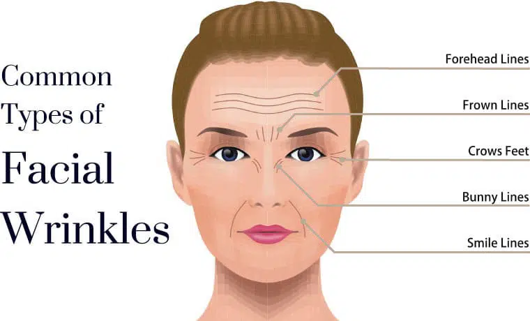 Anti Wrinkle Injections Bulleen