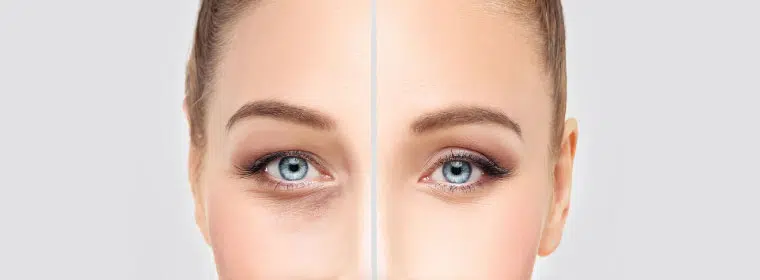 Lower Eyelid Surgery Los Angeles CA | Blepharoplasty - Remove Eye Bags